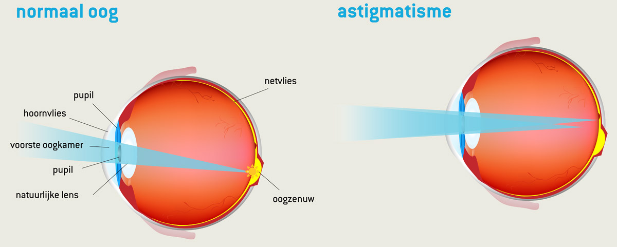 gewoon oog vs astigmatisme